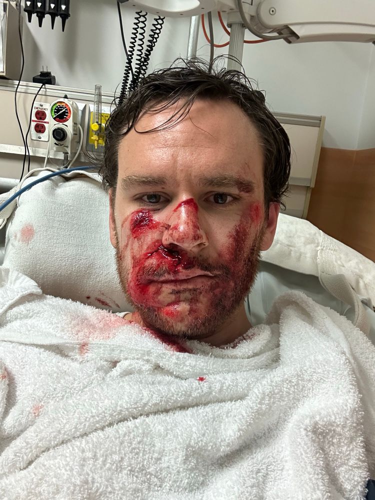 My face after a bike accident