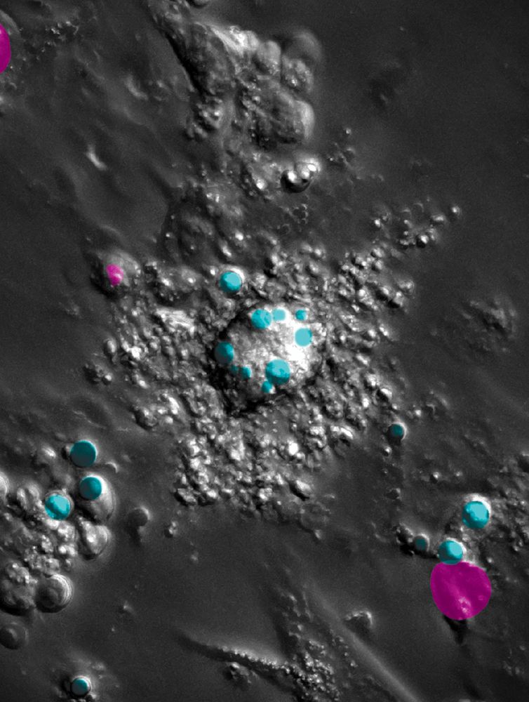 High-resolution microscopy of a mesenchymal cancer cell that has been killed by inactivating the CDS2 gene. Prior to cell death, tiny lipid droplets accumulated, which are still visible as cyan-colored dots, visualized using fluorescence microscopy. The DNA of the dead cancer cells (magenta) is dispersed throughout the surrounding area. 
Processed image by Tim Arnoldus, Gemma Driessen and Marjolein Mertz. Legend: magenta = DNA from dead cancer, cyan = lipid droplets
