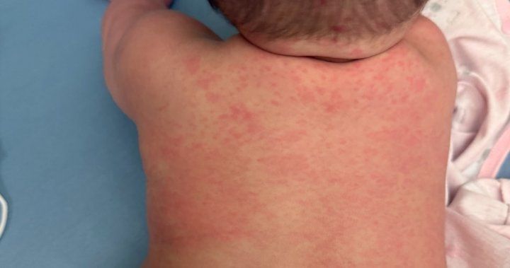 Alberta surpasses all of the United States in confirmed measles cases  | Globalnews.ca
