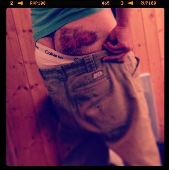 A photogrpah of my bare ass - specifically focused on my right cheek, complete with a big bruise from failing to drop in on a 6ft quarter pipe. I'm wearing white Calvin Klein pants and Altamont shorts, like a right sexy fucker.