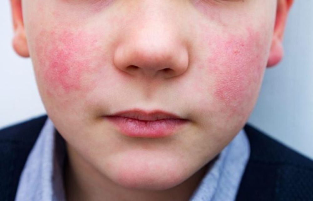 Virus that causes ‘slapped cheek’ rash in kids is rising in US, CDC warns