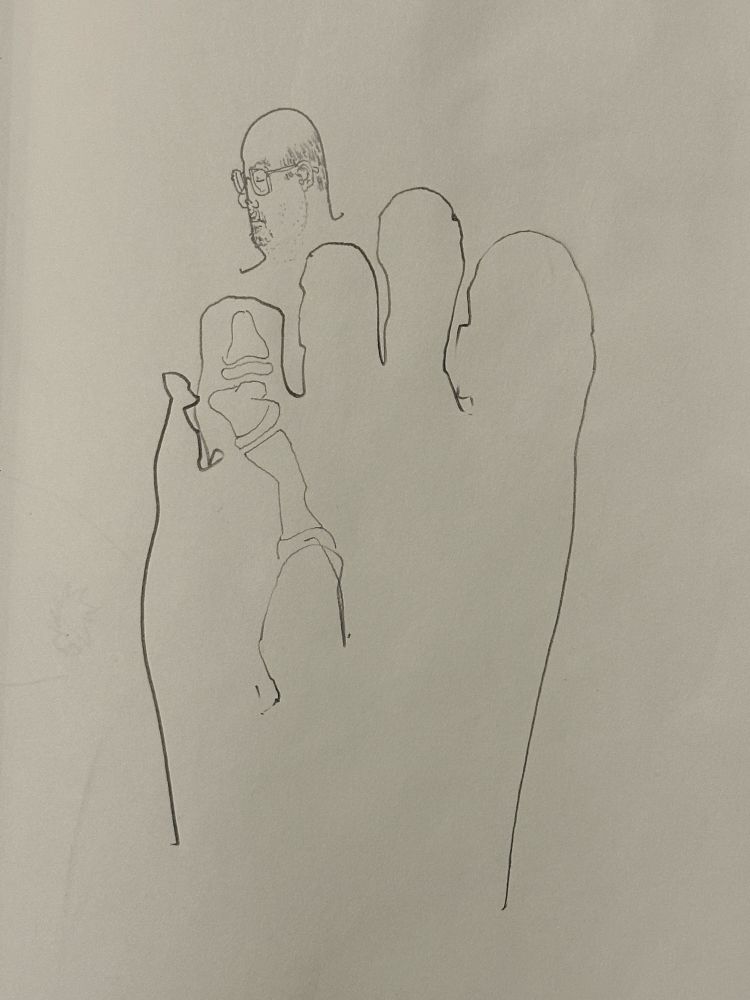 Broke my toe.