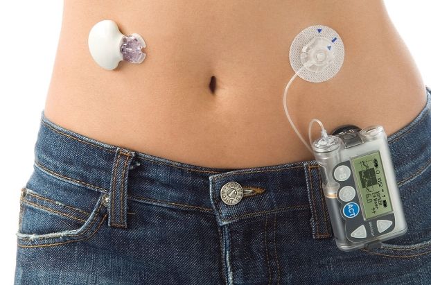 A imagem mostra uma pessoa usando um dispositivo de pâncreas artificial. O dispositivo consiste em dois componentes principais: um sensor aplicado à pele do abdômen, que monitora os níveis de glicose no sangue, e uma bomba de insulina presa à cintura da calça jeans, conectada ao corpo por meio de um pequeno tubo. Esse sistema é usado para gerenciar automaticamente os níveis de glicose, liberando insulina conforme necessário, simulando a função de um pâncreas saudável.