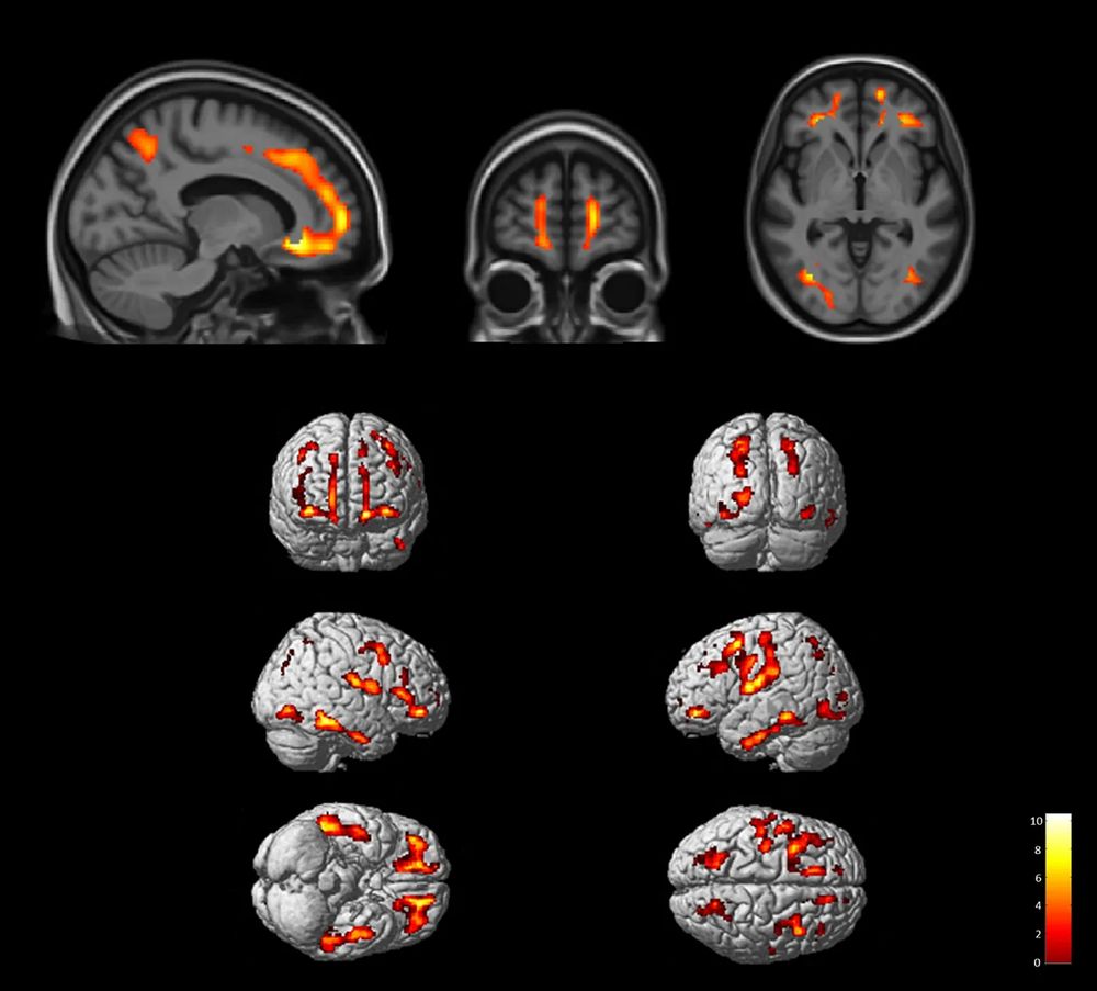Gray brains on black background with certain regions, especially in the frontal region, light up orange and red on PET scan.