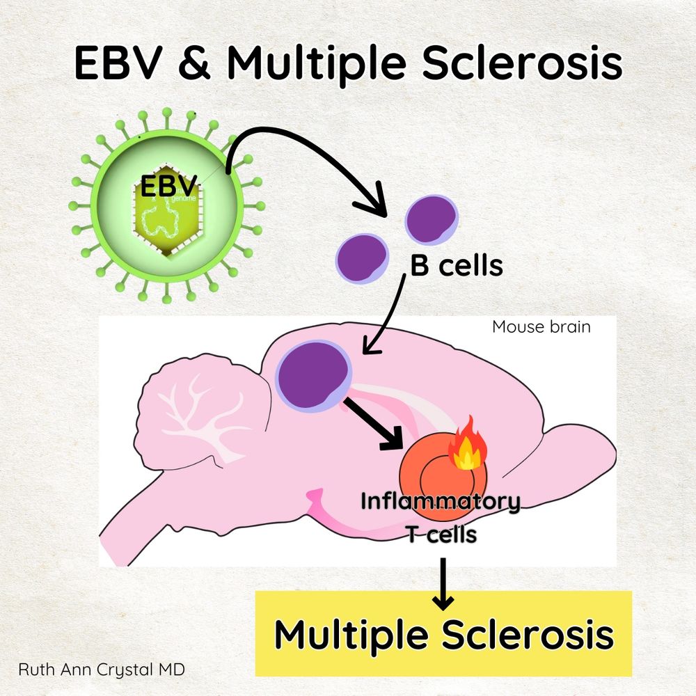 Green EBV virus causes body to make purple B cells which travel to the brain and trigger orange Inflammatory T Cells which leads (arrow to) Multiple Sclerosis (yellow background)