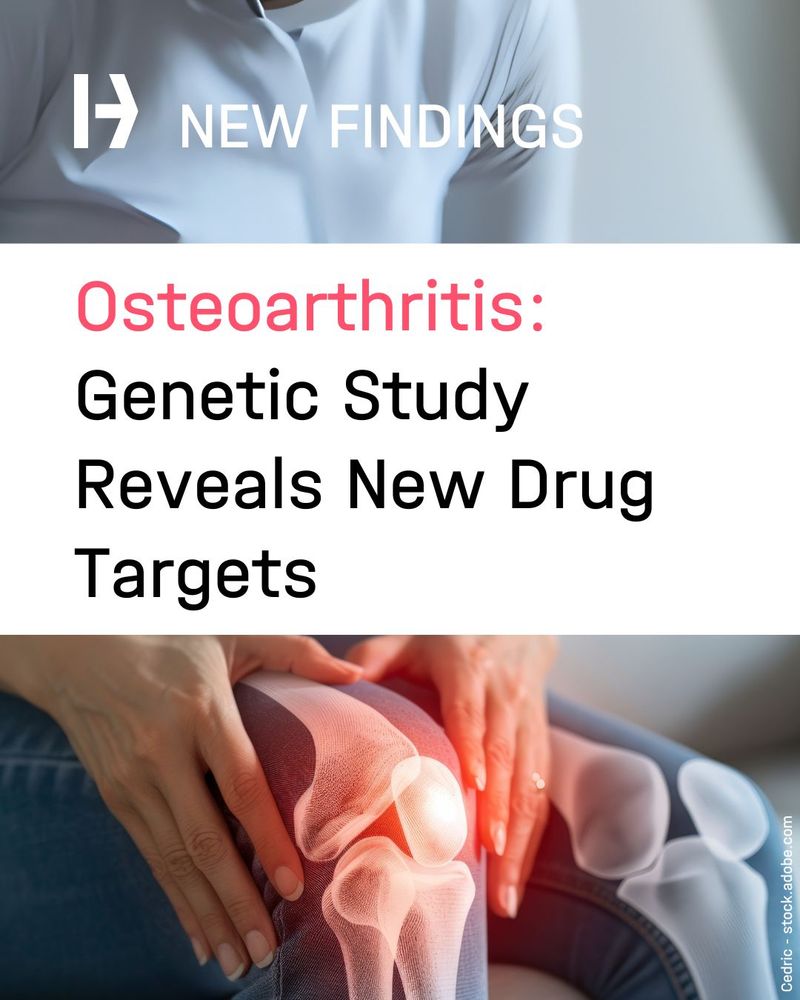 Osteoarthritis – Largest Genetic Study Reveals New Drug Targets