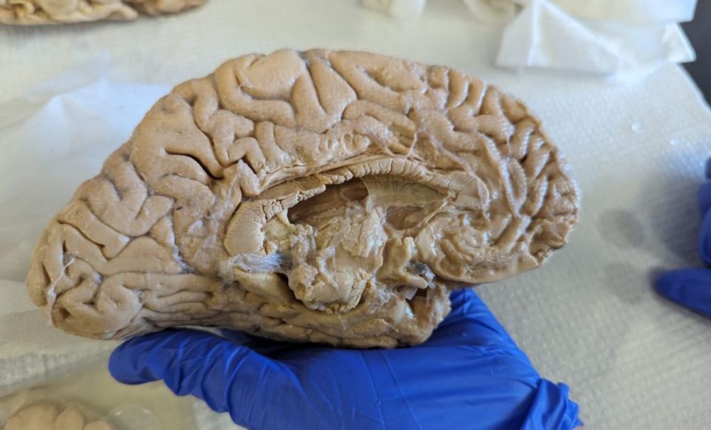 $21 million grant will help UCI push frontiers in Alzheimer’s research