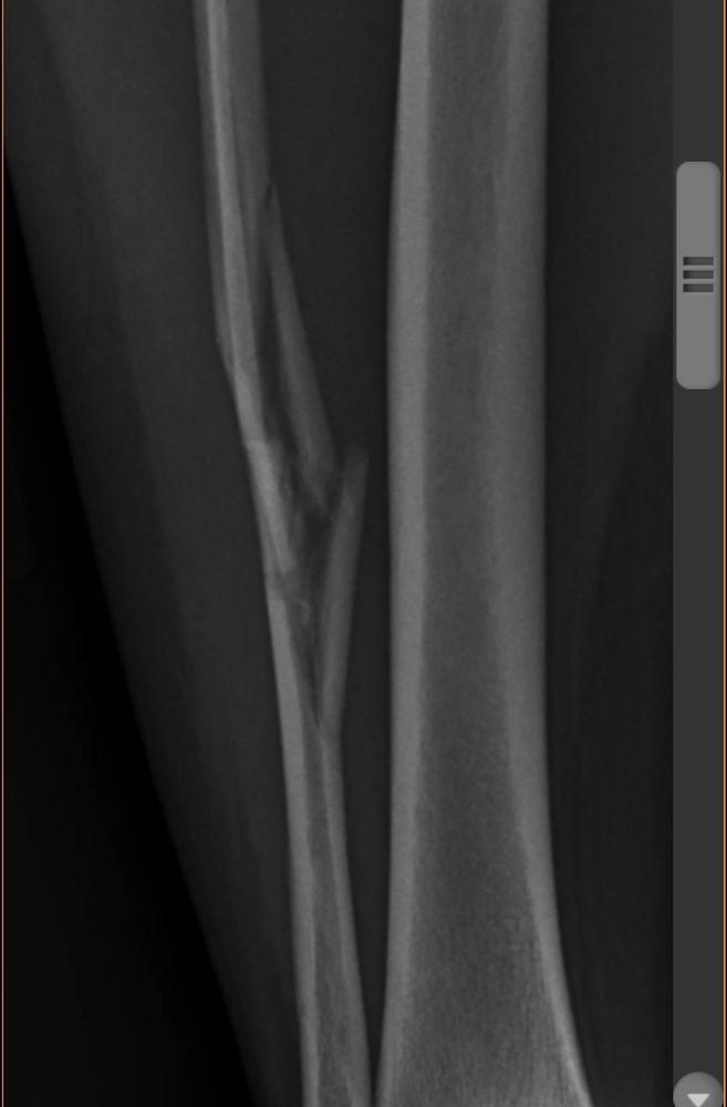 X-ray of splintered fibula 