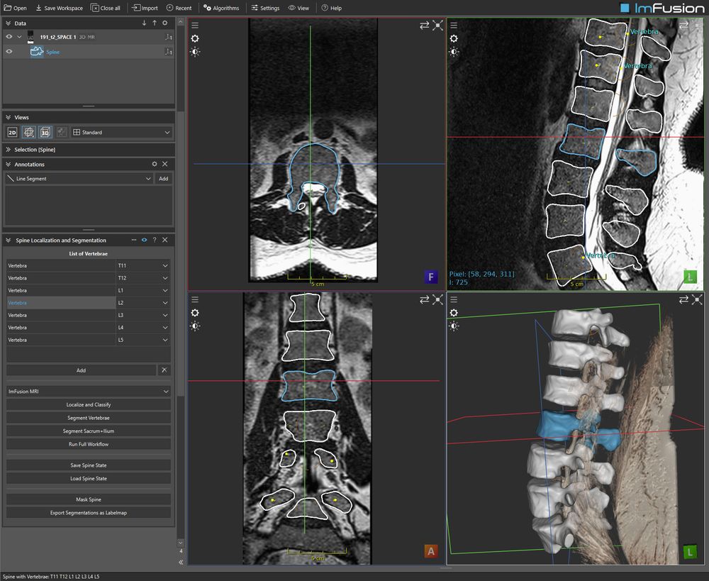 Screenshot of ImFusion Suite's Spine Module, which shows segmented vertebrae in 2D and 3D