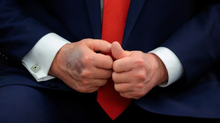 Trump's bruised, tiny hands, August 25, 2025. (Photo by Chip Somodevilla/Getty Images)