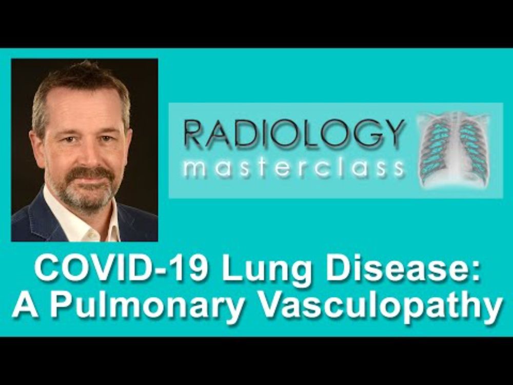COVID-19 Lung Disease: A Pulmonary Vasculopathy