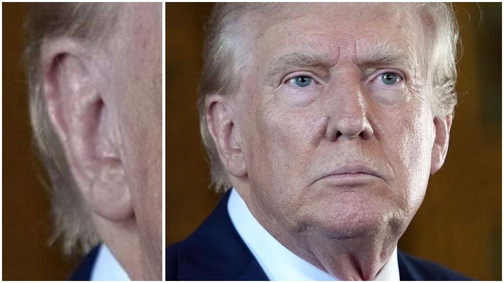 Close-up photo of Trump's right ear 4 weeks after the assassination attempt. 