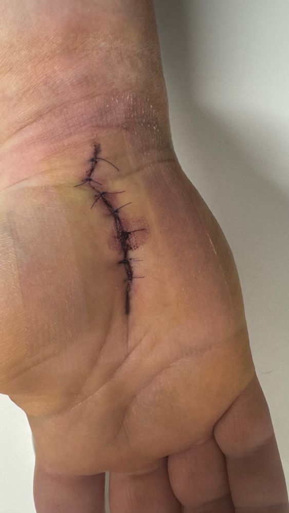 Carpal tunnel surgery scar wit the stitches still visible 