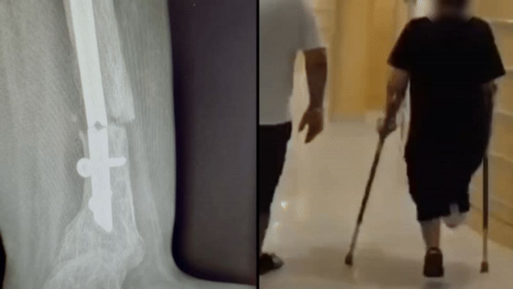 My son’s surgeon told him he could stand. Then his leg snapped