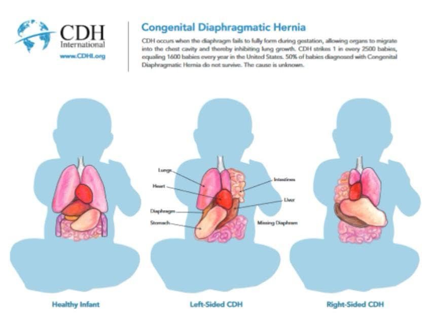 Today is Congenital Diaphragmatic Hernia Awareness Day!

CDH is a birth defect that occurs when a baby’s diaphragm (a thin sheet of muscle that separates the abdomen from the chest) fails to fully form, allowing abdominal organs to enter the chest cavity and prevent lung growth. CDH occurs in approximately 1 in 2500 births, with over 1600 babies diagnosed each year in the United States alone. There is currently no known cause.

Learn more at http://www.cdhawarnessday.org

#cdhawarenessday #cdhcharity #congenitaldiaphragmatichernia #cdhinternational