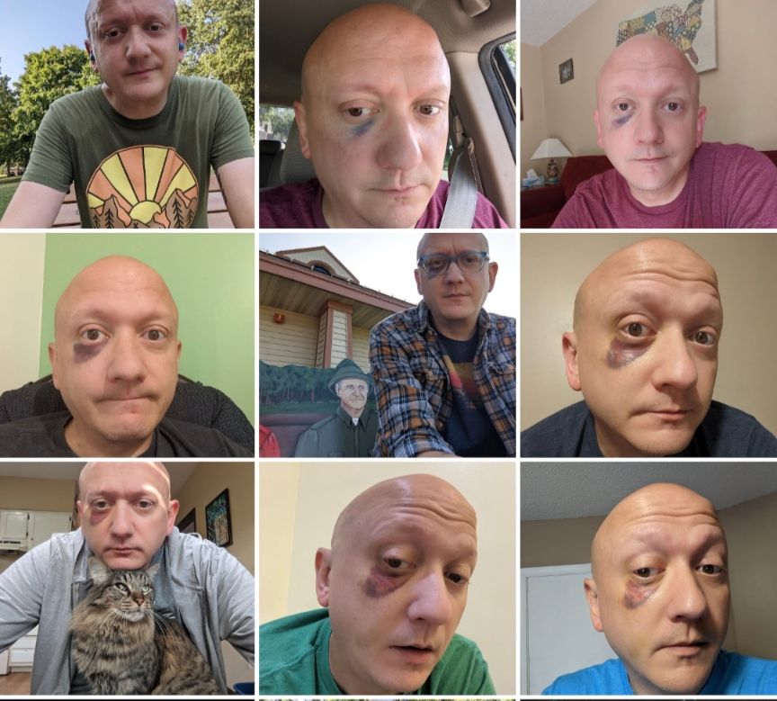 A grid of nine photos in 3 rows of three. All of them are selfies of a bald white man with a black eye in varying stages of progression. The top row is from when it was fresh and not very big or dark. The middle row is when it spread out and got a nice dark purple. The bottom row is when it started to turn sort of greenish and yellow. In the picture in the bottom right corner you can't really see it but the blood had started to move from the black eye and was settling along my chin/jaw. That was a weird thing I didn't expect to happen. In the bottom left photo I'm with my cat Meatloaf. He doesn't seem bothered by the black eye unlike my housemate at the time, Alex, who told me I needed to put makeup on it so he didn't have to look at it anymore. Alex has Down Syndrome and has always been honest with me in our friendship. The black eye was given to me by our other housemate George. I don't hold it against him. He is still one of my favorite people. I think Alex, on the other hand, might still be holding a bit of a grudge against George because of it. 
