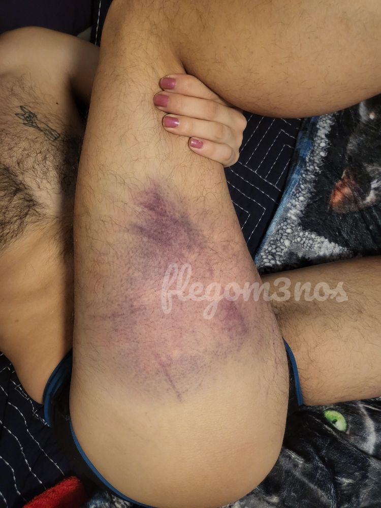 focused on the outer thigh, a combination of shallow and deep purple bruises. user watermark.