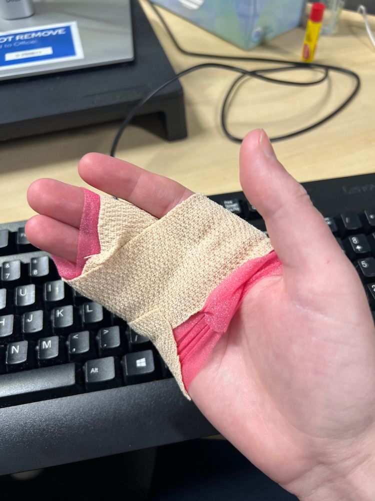 An image of a bandaged right hand, the last three fingers wrapped together as well as the knuckles.