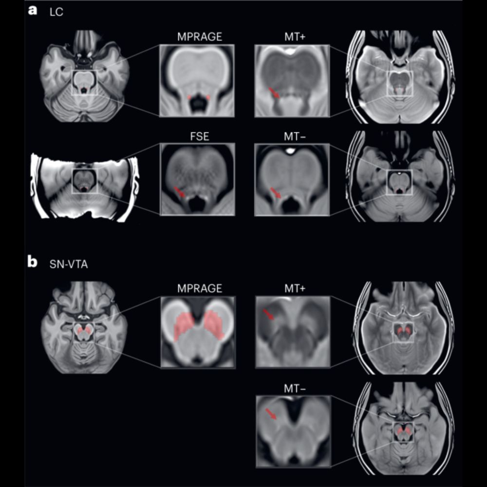 The integrity of dopaminergic and noradrenergic brain regions is associated with different aspects o...