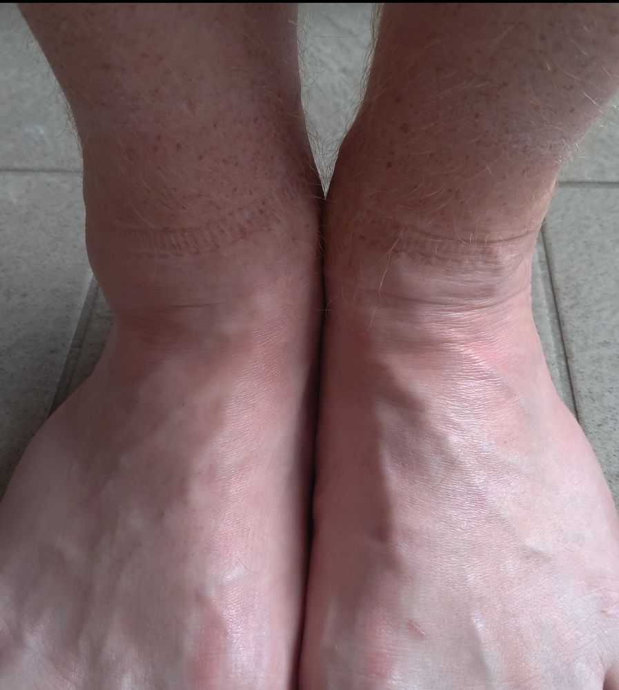 a photo of (my) ankles, my left is rather swollen! 