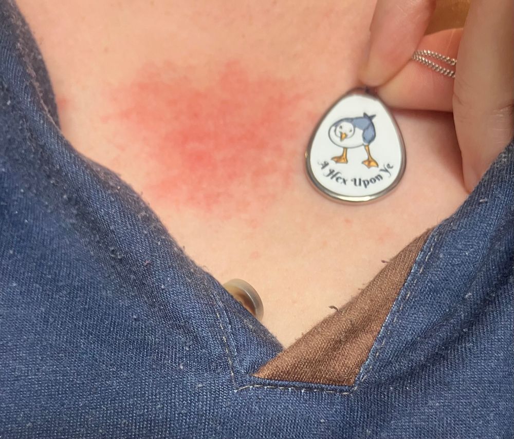 Photo of OP’s upper chest, covered in a bumpy red rash. Beside the rash is the pendant of a necklace showing a seagull, with the words “A Hex Upon Ye” written in script underneath. The pendant is approximately the same size as the rash. 