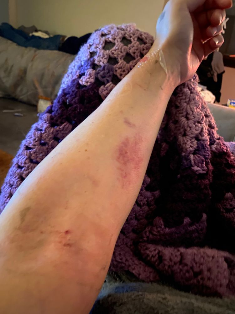 my left arm all fucked up from bad needle placement 