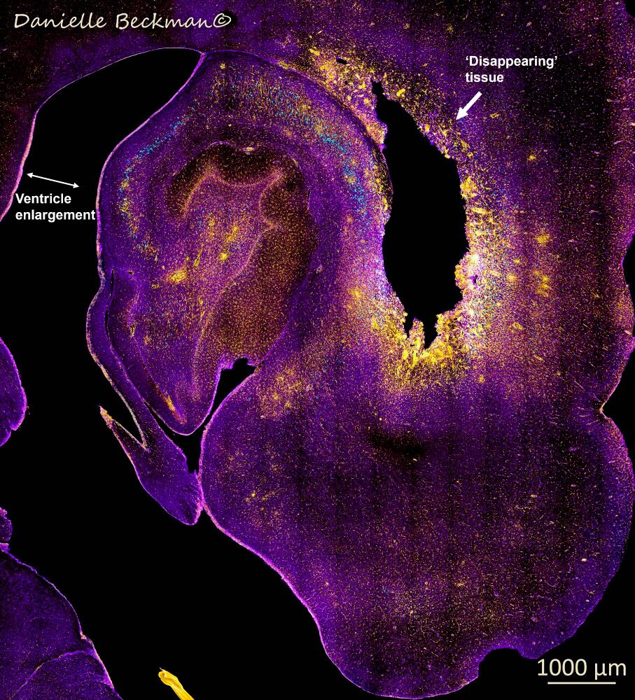 Microscopy photo showing brain atrophy with Alzheimer