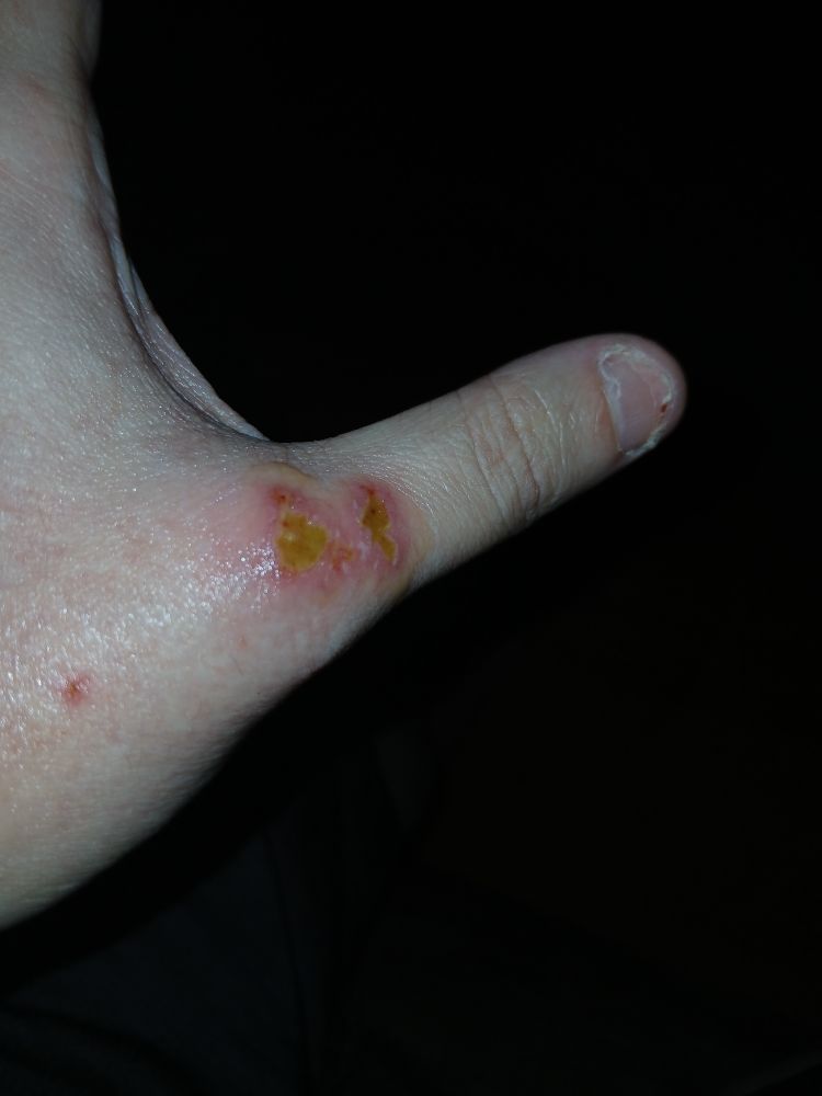 A picture of my thumb showing 2 deep tissue wounds to the large knuckle.