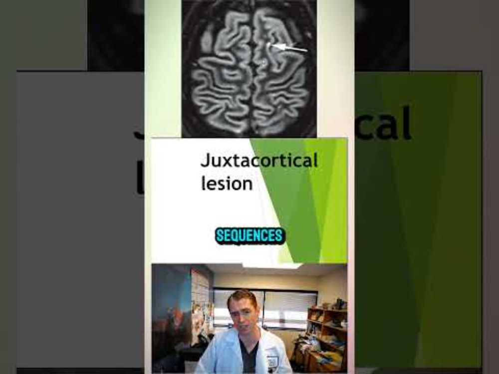 Multiple Sclerosis Juxtacortical Lesions