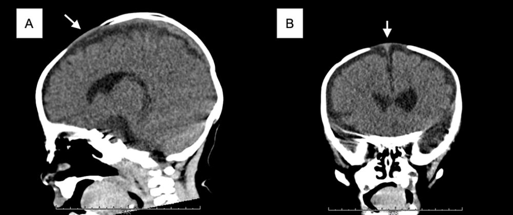 An Infant With COVID-19 Presenting With a Bulging Fontanel: A Case Report and Literature Review