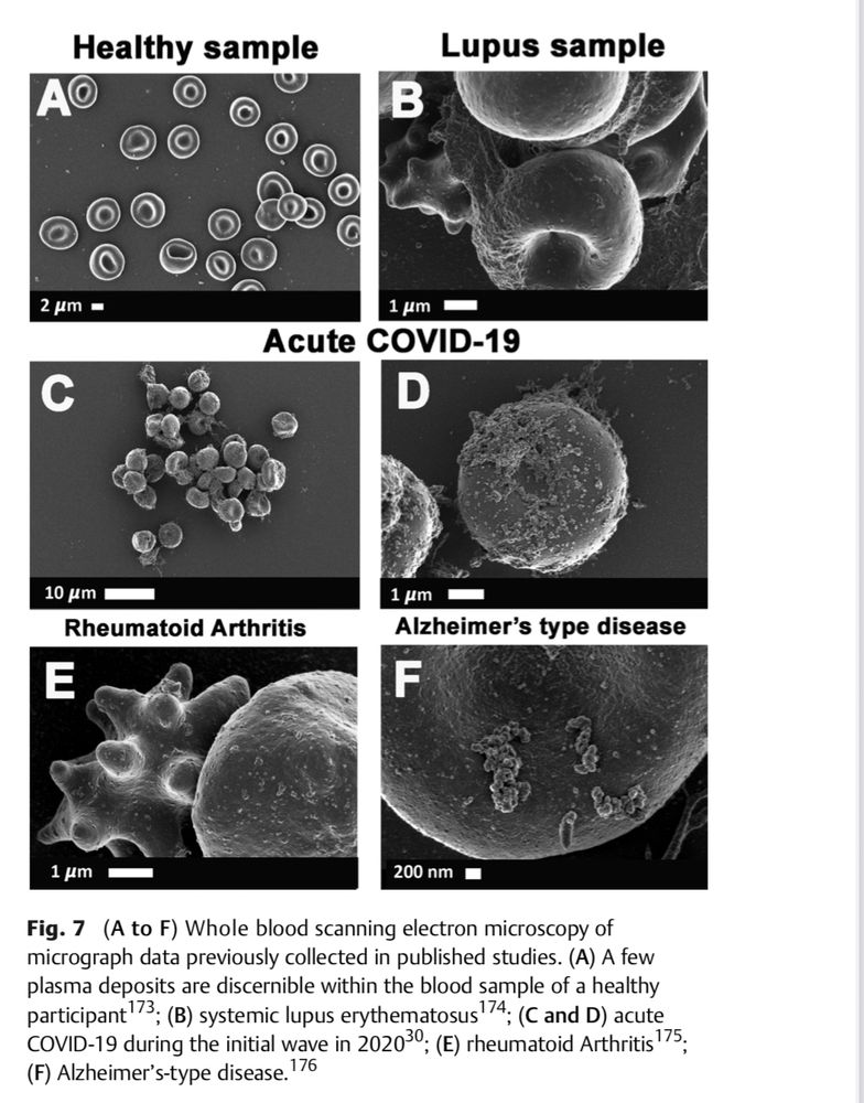 (A to F) Whole blood scanning electron microscopy of micrograph data previously collected in published studies. (A) A few plasma deposits are discernible within the blood sample of a healthy participant 173
; (B) systemic lupus erythematosus174; (C and D) acute
COVID-19 during the initial wave in 202030; (E) rheumatoid Arthritis;
(F) Alzheimer's-type disease.
176