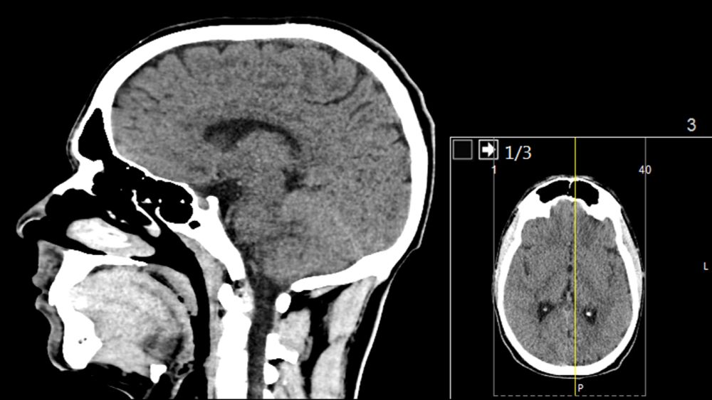 Study shows that COVID-19 causes cognitive decline among those without long COVID symptoms