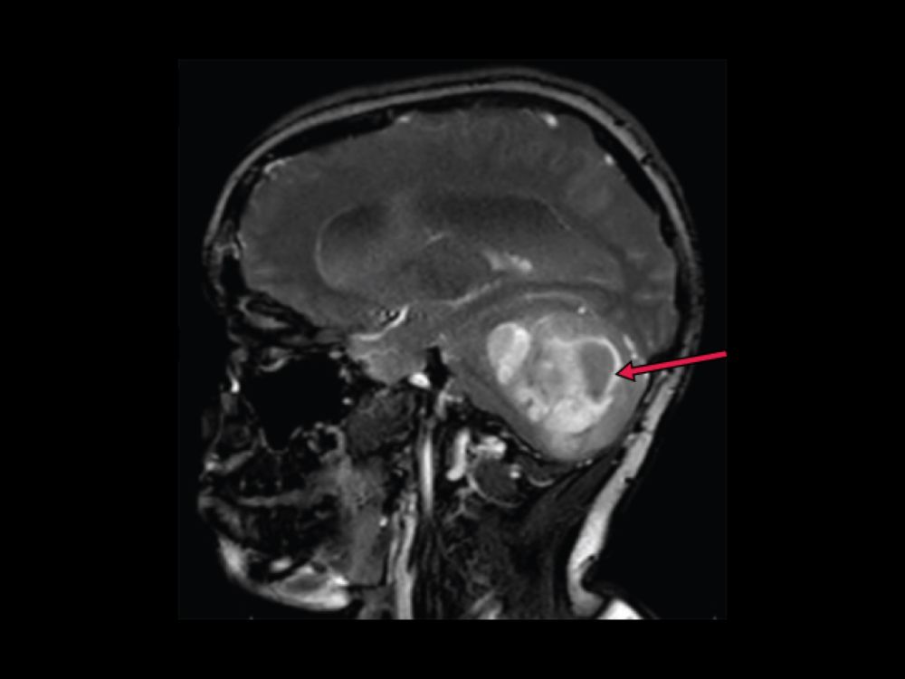 BRAF-Targeted Drug Approved for Pediatric Low-Grade Glioma