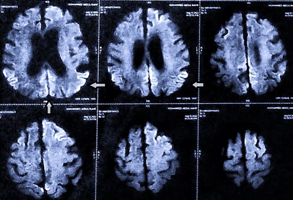 Unusually Late Onset of Creutzfeldt-Jakob Disease Following COVID-19 Infection in India: A Case Report