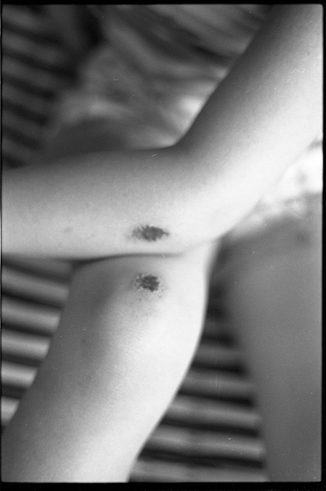 This black-and-white photograph is of my daughter as a child. About a week before this photo was taken, she fell off her bike. It shows a scab on her left elbow and right knee.
