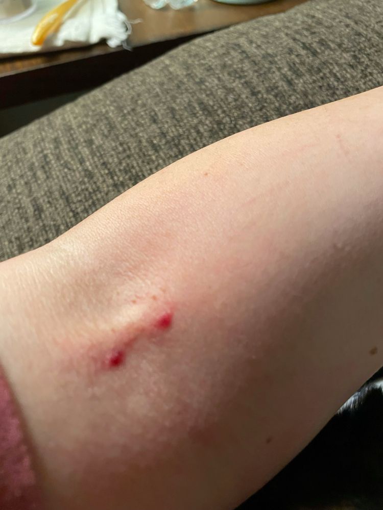 Vampire bite on my arm. 