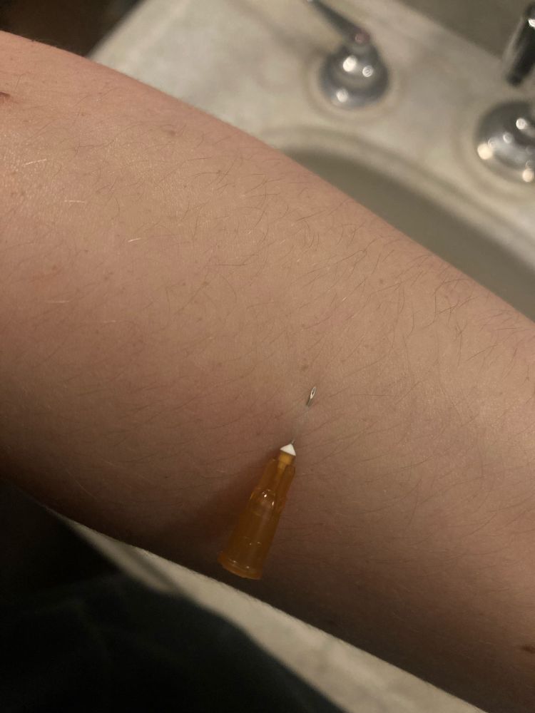 My arm with a needle stuck through it so that the tip sticks out of my skin.