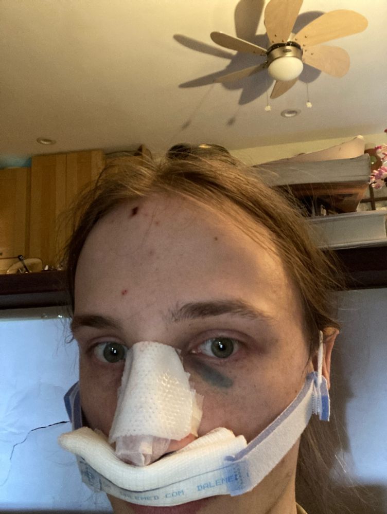 A selfie of me with a cast over my nose and a gauze pad under it to catch blood drips. My eyes are heavily bruised and my face is swollen.