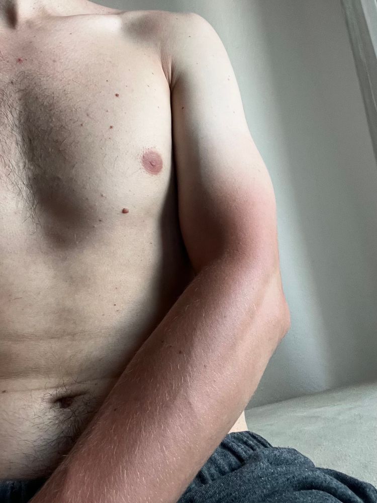 Idiot that spent too much time in the sun with a shirt on showing his tanned arm in comparison to his untanned shoulders and torso