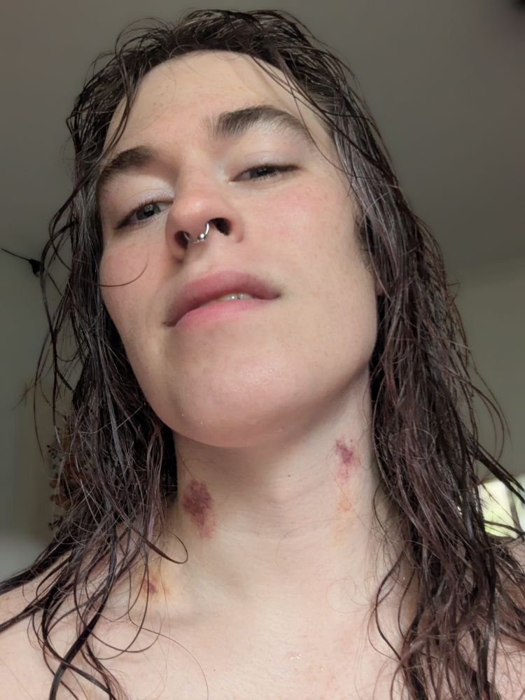 Selfie of me with wet hair looking down at the camera with bite marks on my neck.