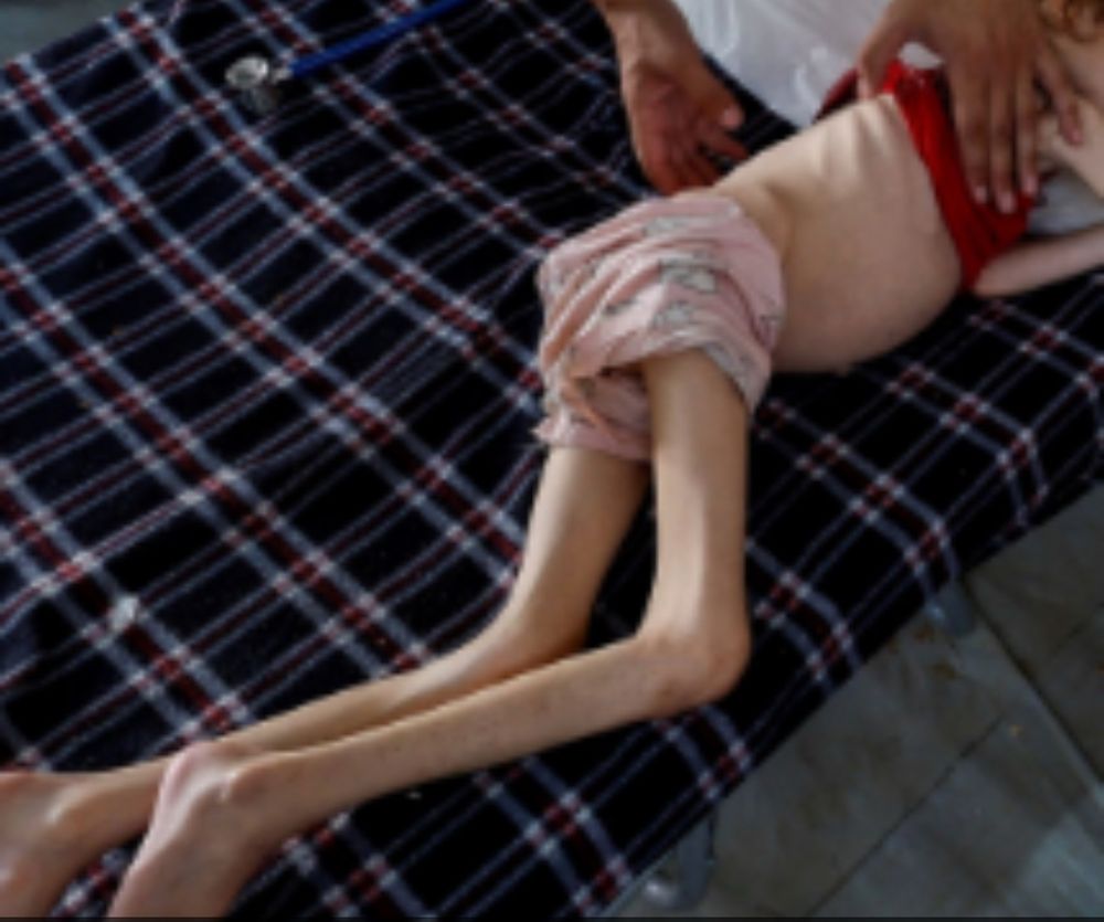 A picture of the legs and torso of a starving child lying on a bed covered in a blue check.