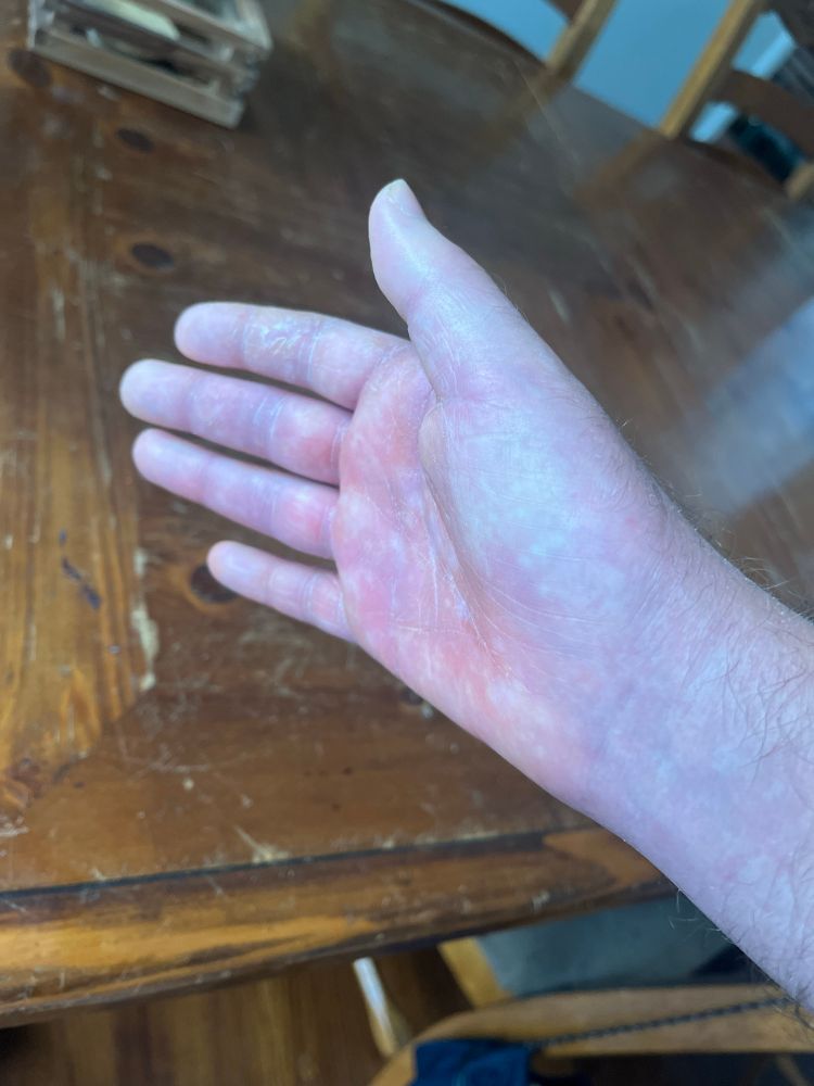 my right hand a month post elbow surgery looking like a water balloon full of blood