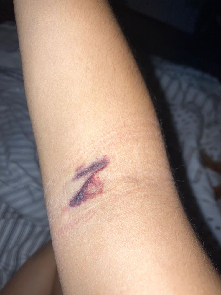 A bruise that looks like the letter Z on an arm