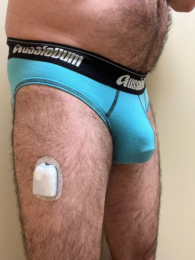A side pic of a person’s bare legs and tummy, with an insulin pump on one leg. The person is wearing blue briefs.