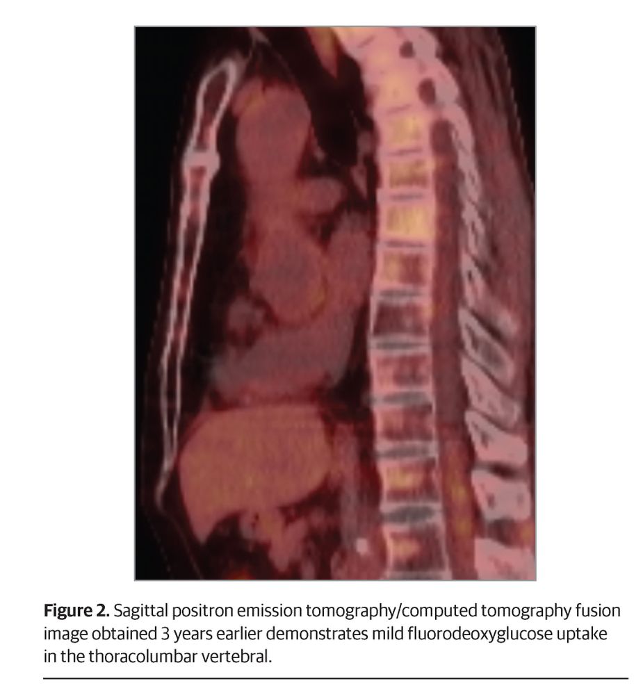 Sagittal PET/CT fusion image displaying the human torso from a side view. The scan shows mild fluorodeoxyglucose uptake in the thoracolumbar vertebral region, highlighting the spinal area within the body.