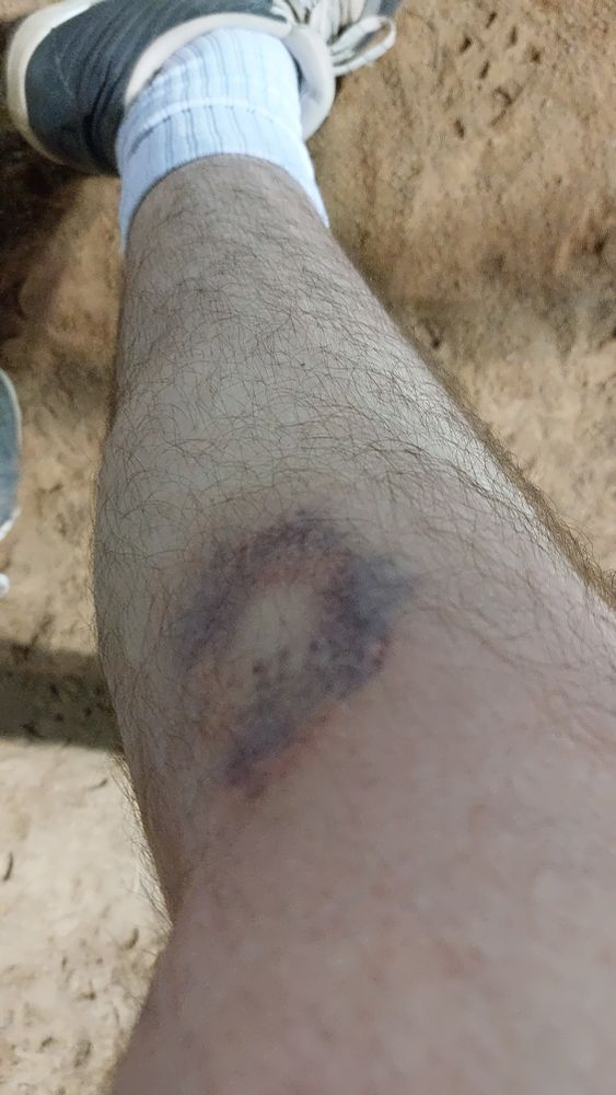 A photo of my right leg, taken from my waist, with my sock and cleat visible away from the camera. The photo is focused on a giant bruise just below my knee. You can see the stitching from the softball where it struck me. Hardest I've ever been hit in a game (OW).