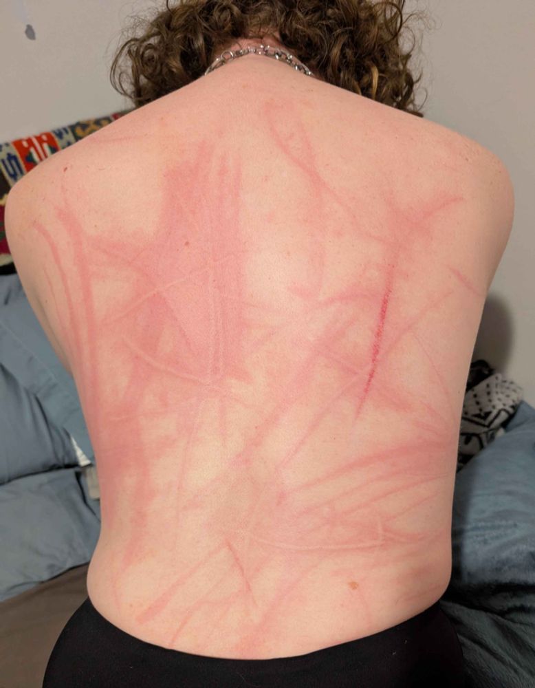 Me with my back all scratched up