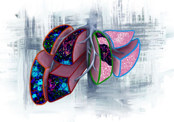 The image illustrates the four prognostic liver lobes in the pre-metastatic liver: liver metastasis within 6 months (orange outline), liver metastasis after 6 months (red outline), metastases outside of liver (green outline), and normal liver with fatty liver and no evidence of cancer (light blue outline). Photo credit: Vanessa Dudley