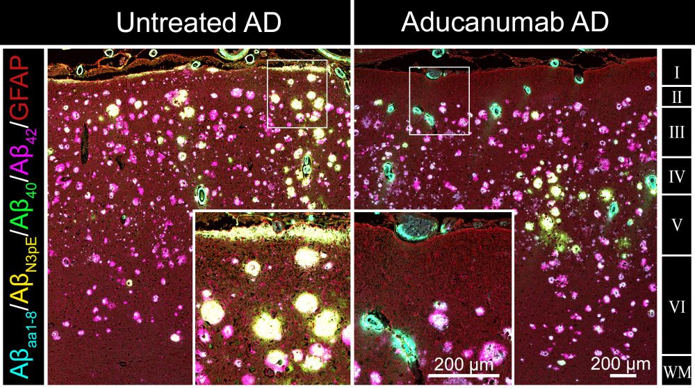Multiplex immunofluorescence of Aβ species