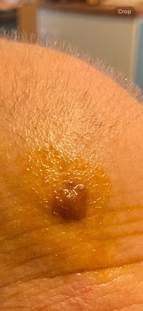 This is mid way through, I do not have the date the growth crusted over and fell off over time leaving healthy normal looking skin behind.  Why don’t the researchers study that. Shrinking spot covered with RSO oil that dissolved a skin growth gradually by being applied daily